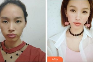 赤峰現(xiàn)代婦產(chǎn)醫(yī)院醫(yī)療美容科朱莉整形價(jià)格表附鼻部綜合案例展示