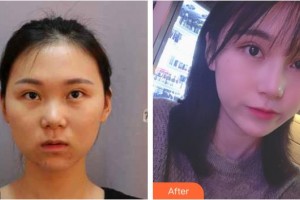 赤峰現(xiàn)代婦產(chǎn)醫(yī)院醫(yī)療美容科黃罡整形價格表附鼻部綜合案例展示