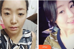 赤峰麗都整形美容醫(yī)院潘福強整形價格表附鼻部綜合案例展示