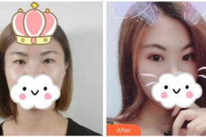 赤峰朝聚眼科醫(yī)院周躍華整形價格表附眼部綜合案例展示