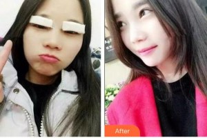 通遼施介醫(yī)院整形美容中心王瑞芝整形價格表附埋線雙眼皮案例展示