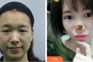 通遼京韓創(chuàng)美醫(yī)療美容診所子墨整形價格表附切開雙眼皮案例展示