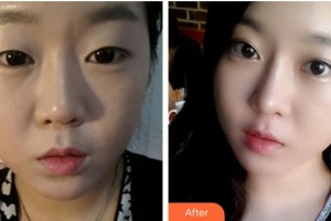 通遼新時代醫(yī)療美容診所吳瓊整形價格表附切開雙眼皮案例展示