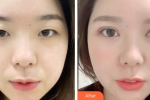 通遼京韓創(chuàng)美醫(yī)療美容診所傅群整形價格表附切開雙眼皮案例展示