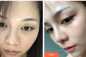 鄂爾多斯百達(dá)麗整形美容醫(yī)院劉林整形價格表附激光祛斑案例展示