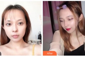 鄂爾多斯天王醫(yī)學(xué)美容醫(yī)院趙娜整形價格表附微針美膚案例展示