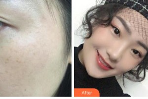 鄂爾多斯武瑞明醫(yī)學(xué)美容整形醫(yī)院武瑞明整形價格表附激光祛斑案例展示