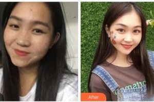 鄂爾多斯市中心醫(yī)院燒傷整形科郭勝利整形價格表附激光祛斑案例展示