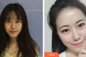 鄂爾多斯天王醫(yī)學(xué)美容醫(yī)院梁曉健整形價(jià)格表附無針?biāo)獍咐故?>
</a>
<h3 class=