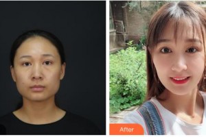 呼倫貝爾周彩蓮醫(yī)療美容診所周彩蓮整形價(jià)格表附眼部綜合案例展示