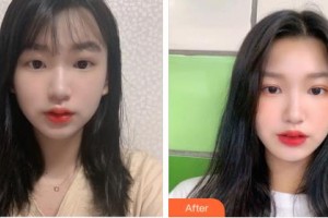 巴彥淖爾張紅田醫(yī)療整形美容診所張紅田整形價格表附眼部綜合案例展示