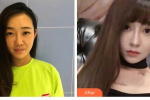 吉林市人民醫(yī)院整形美容科孟強整形價格表附微針美膚案例展示