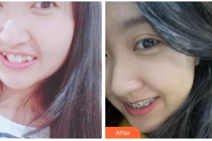 吉林銘醫(yī)整形美容醫(yī)院吳迪整形價格表附金屬托槽矯正案例展示