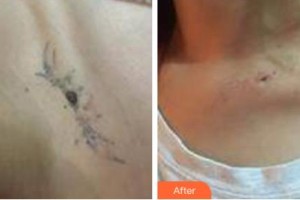 吉林銘醫(yī)整形美容醫(yī)院白英浩整形價格表附激光去紋身案例展示