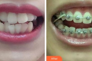 吉林大學口腔醫(yī)院口腔頜面外科徐洋整形價格表附金屬托槽矯正案例展示