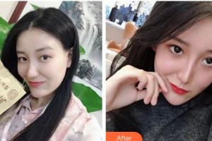 吉林吉化集團總醫(yī)院燒傷整形科田寶祥整形價格表附清潔祛痘案例展示