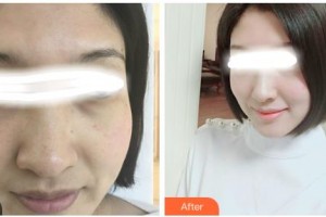 吉林吉化集團總醫(yī)院燒傷整形科劉鳳彬整形價格表附美白嫩膚案例展示