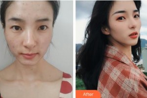 吉林大學第一醫(yī)院整形美容科彭維海整形價格表附激光祛斑案例展示