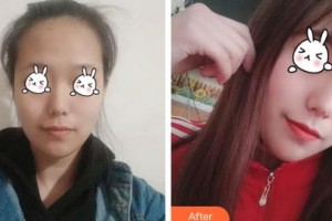 吉林大學(xué)第一醫(yī)院整形美容科林泉整形價格表附光子嫩膚案例展示