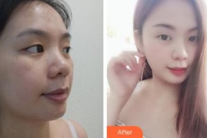 吉林大學第一醫(yī)院整形美容科張舵整形價格表附無針水光案例展示