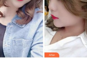 吉林大學(xué)第一醫(yī)院整形美容科金洪娟整形價格表附激光祛斑案例展示