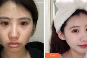 吉林國健整形美容醫(yī)院柳濟(jì)圣整形價格表附激光祛斑案例展示