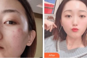 吉林瑞澳醫(yī)學(xué)美容醫(yī)院魏軍劍整形價格表附激光祛斑案例展示