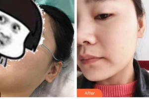 吉林省公安邊防總隊醫(yī)院醫(yī)整形美容中心張國強整形價格表附光子嫩膚案例展示