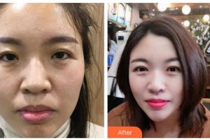 吉林省公安邊防總隊醫(yī)院醫(yī)整形美容中心王軍整形價格表附彩光嫩膚案例展示