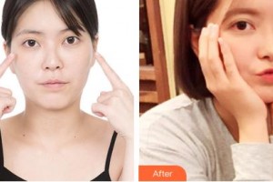 吉林市中心醫(yī)院燒傷整形外科王大壯整形價格表附開內(nèi)眼角案例展示