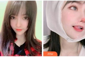 吉林市中心醫(yī)院燒傷整形外科趙鐵成整形價格表附切開雙眼皮案例展示