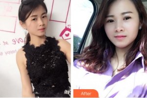 吉林大學(xué)中日聯(lián)誼醫(yī)院燒傷整形外科王之清整形價格表附切開雙眼皮案例展示