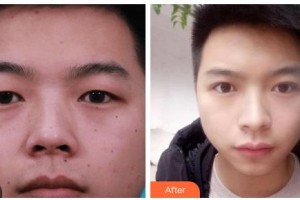 吉林瑞澳醫(yī)學(xué)美容醫(yī)院井明整形價格表附切開雙眼皮案例展示