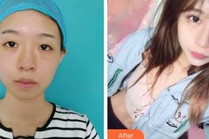 吉林市中心醫(yī)院燒傷整形外科劉長城整形價格表附眼部綜合案例展示