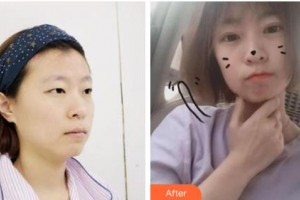 長(zhǎng)春韓一美容醫(yī)院李鐘奇整形價(jià)格表附切開(kāi)雙眼皮案例展示