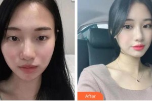 長(zhǎng)春秀爾醫(yī)療美容診所樸永男整形價(jià)格表附眼部修復(fù)案例展示