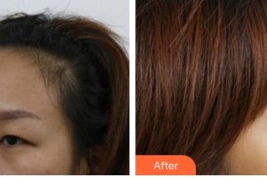 長(zhǎng)春愛(ài)麗醫(yī)療美容門診部金詠晙整形價(jià)格表附上眼瞼去脂案例展示