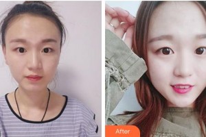 長(zhǎng)春西之米醫(yī)療美容醫(yī)院徐嘉整形價(jià)格表附切眉術(shù)案例展示