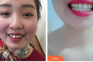 長(zhǎng)春珍妮醫(yī)療美容醫(yī)院王廣平整形價(jià)格表附牙齒隱形矯正案例展示