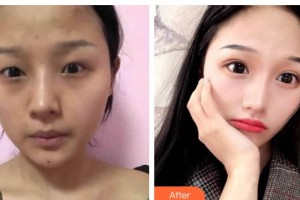 長春圣華抗衰老醫(yī)學研究院張曼整形價格表附切開雙眼皮案例展示