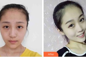 長(zhǎng)春姜醫(yī)生醫(yī)療美容診所姜廣霞整形價(jià)格表附切開(kāi)雙眼皮案例展示