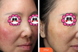 長春奧拉克美容醫(yī)院雅卓整形價格表附激光去紅血絲案例展示