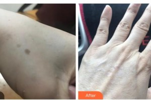 長春中妍醫(yī)療美容醫(yī)院韓柏宏整形價格表附激光祛斑案例展示