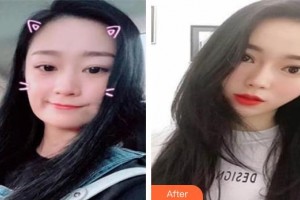 長春美奇醫(yī)療美容外科門診部呂永濤整形價格表附埋線提升案例展示