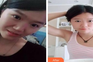 長春秀爾醫(yī)療美容診所張興祺整形價格表附埋線提升案例展示