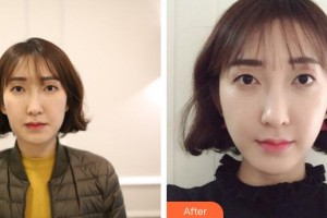 長春瑞爾麗整形美容門診部姜宗和整形價(jià)格表附超聲提拉案例展示