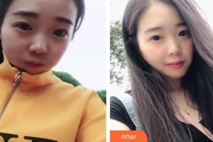 長春尚顏康醫(yī)療美容門診部劉仁漢整形價格表附超聲提拉案例展示