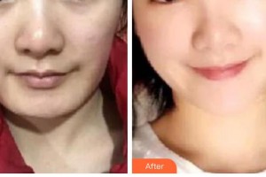 長春中妍醫(yī)療美容醫(yī)院王珊珊整形價格表附埋線提升案例展示