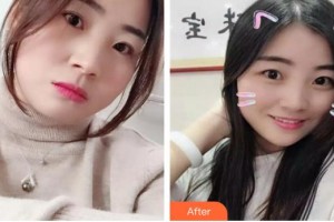 長春奧拉克美容醫(yī)院侯克整形價(jià)格表附埋線提升案例展示