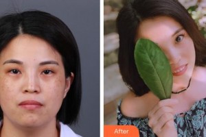 長春奧拉克美容醫(yī)院高微整形價格表附微針水光案例展示